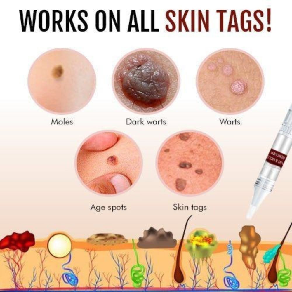 Skin Tag Mole Remover Pen With Tea Tree Oil Fast Household