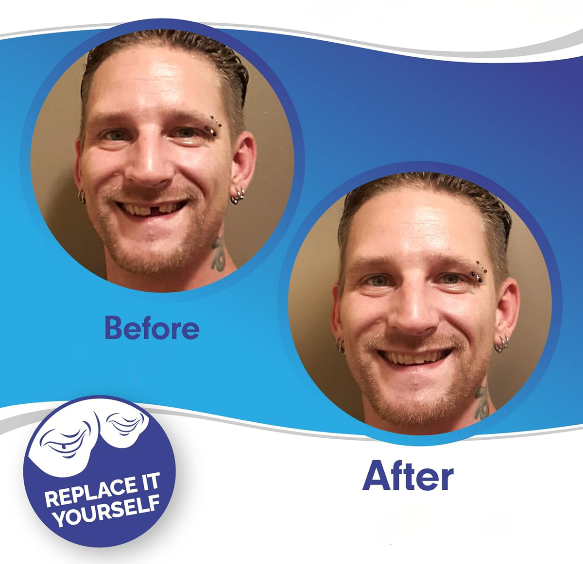Veneers Smile Upper And Lower Instant Cover For All Day