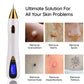 Mole Remover Pen At Household Skin Tag Removal Painless Fast