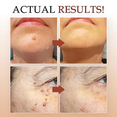 Skin Tag Mole Remover Pen With Tea Tree Oil Fast Household