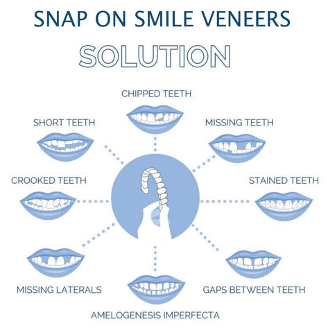 Veneers Smile Upper And Lower Instant Cover For All Day